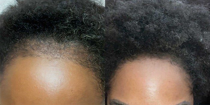 AnteAGE MDX Hair Microneedling Solution results